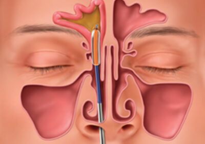 Chronic Sinusitis Treatment Glendale