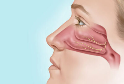 ClariFix Treatment in Glendale & Burbank, CA - After Image - (SCENTAA)