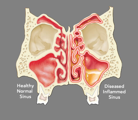 Propel Sinus Stent for Chronic Sinusitis Glendale & Burbank, CA - (SCENTAA)