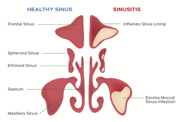 Chronic Sinusitis Glendale & Burbank