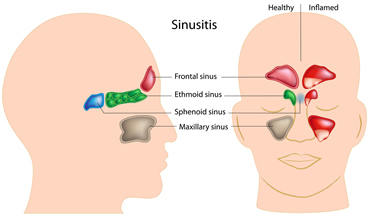 Treating Chronic Sinusitis With Balloon Sinuplasty - Southern California ENT and Allergy Associates