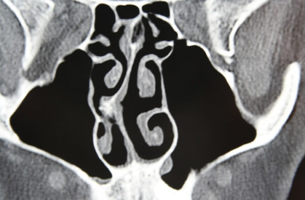 Septal Deviation Treatment in Glendale & Burbank - Southern California ENT and Allergy Associates