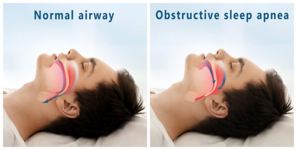 Normal airway vs obstructive sleep apnea - Southern California ENT and Allergy Associates