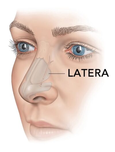 LATERA® Stent in Glendale & Burbank, CA - Southern California ENT and Allergy Associates