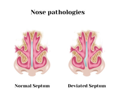 Difficulty Breathing / Congestion - Southern California ENT and Allergy Associates
