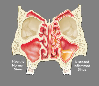 Propel Sinus Stent for Chronic Sinusitis in Glendale & Burbank, CA - Southern California ENT and Allergy Associates