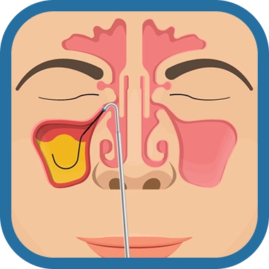 balloon sinuplasty step 1 - Southern California ENT and Allergy Associates