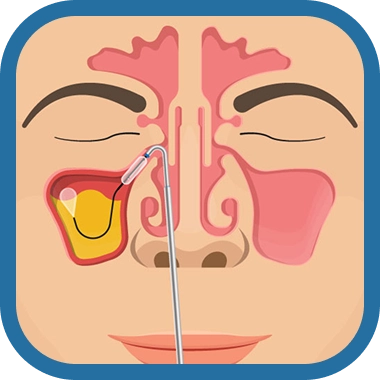 balloon sinuplasty step 2 - Southern California ENT and Allergy Associates