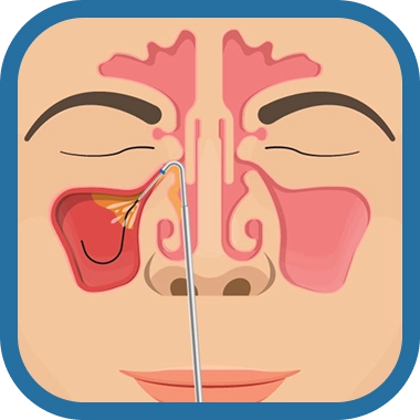 balloon sinuplasty step 3 - Southern California ENT and Allergy Associates