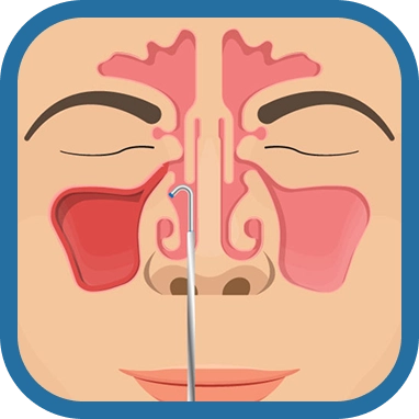 balloon sinuplasty step 4 - Southern California ENT and Allergy Associates