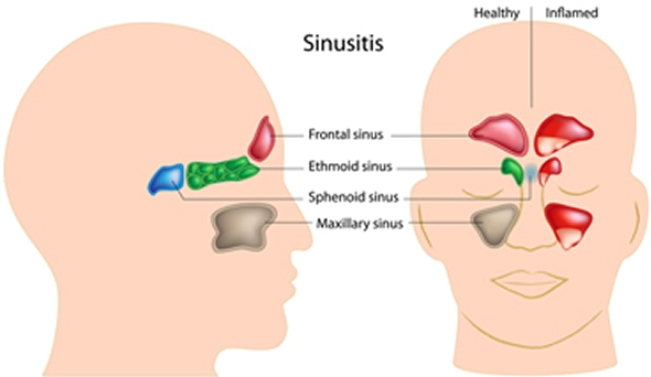 Treating Chronic Sinusitis With Balloon Sinuplasty - Southern California ENT and Allergy Associates