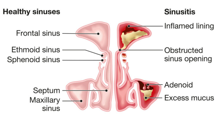 Chronic Sinusitis Glendale & Burbank - Southern California ENT and Allergy Associates