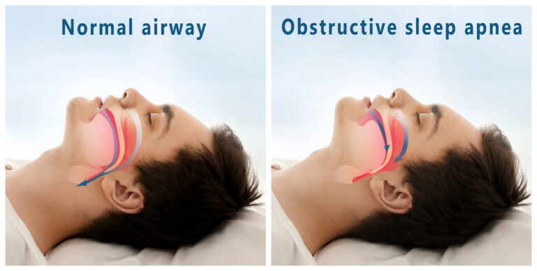 Normal airway vs obstructive sleep apnea - Southern California ENT and Allergy Associates